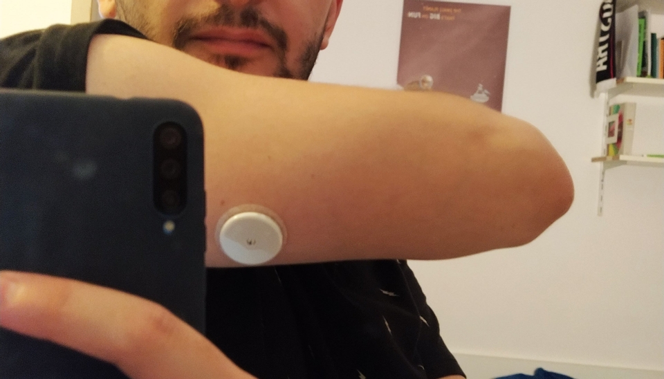 Continous Glucose Monitor shown on arm