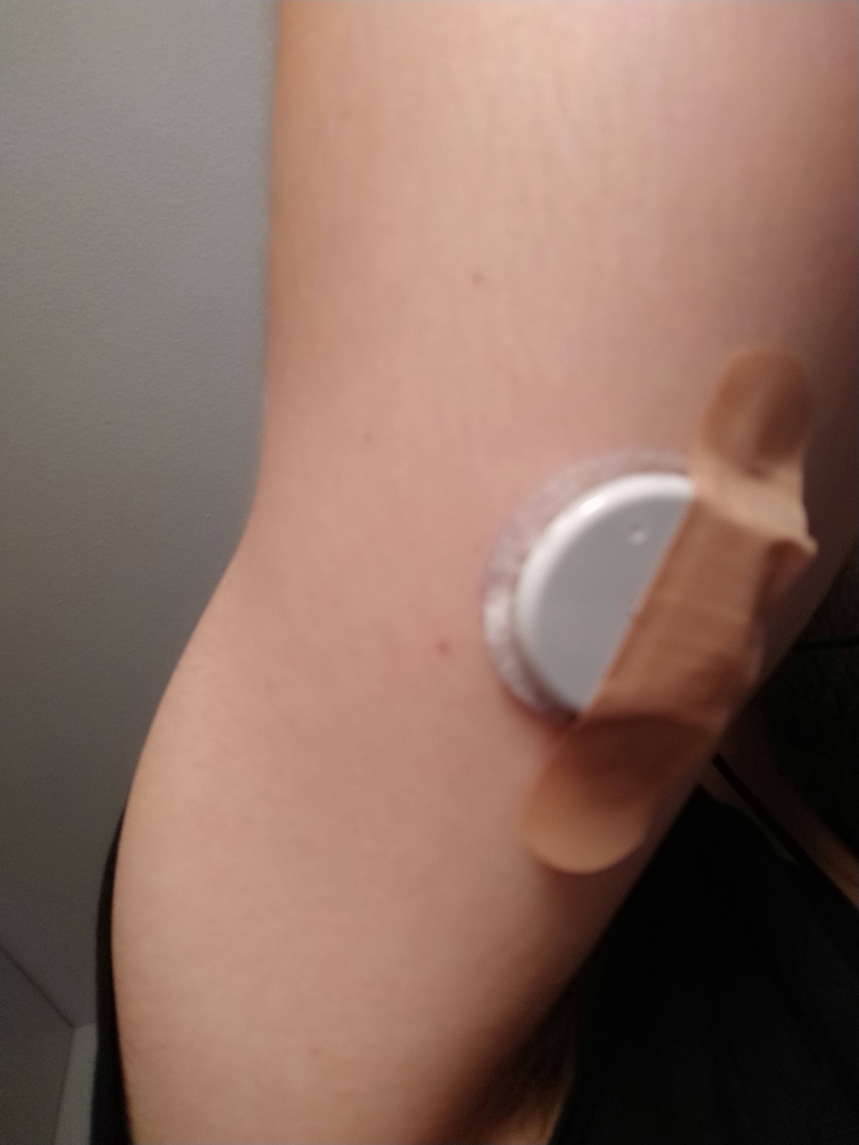 Continous Glucose Monitor shown on arm